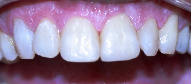 Marked & Stained Teeth