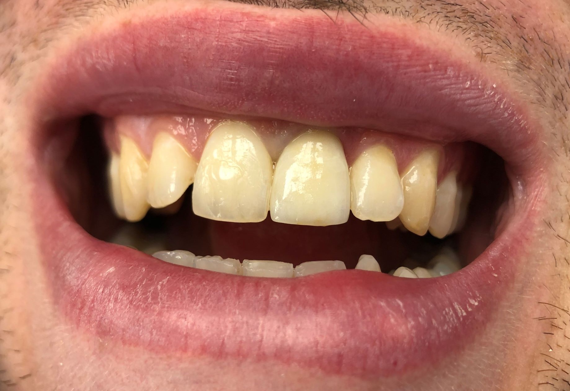 Dental Crown replacement