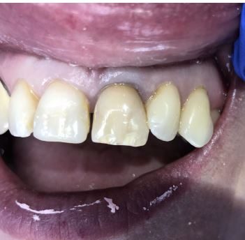 Dental Crown replacement